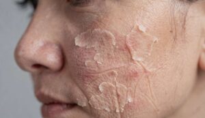 Sucha skóra w sezonie grzewczym: co radzą polscy dermatolodzy z PTD